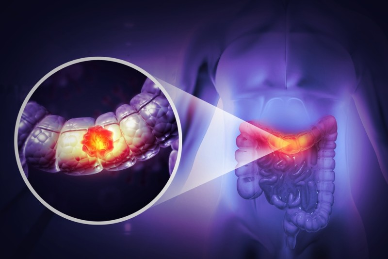 Imaginea ilustreaza un cancer de colon, mai exact o formatiune tumorala localizata pe peretele colonului