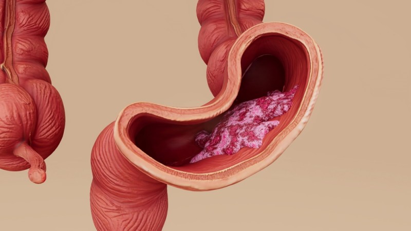 Infografic cu factorii de risc pentru cancerul de colon