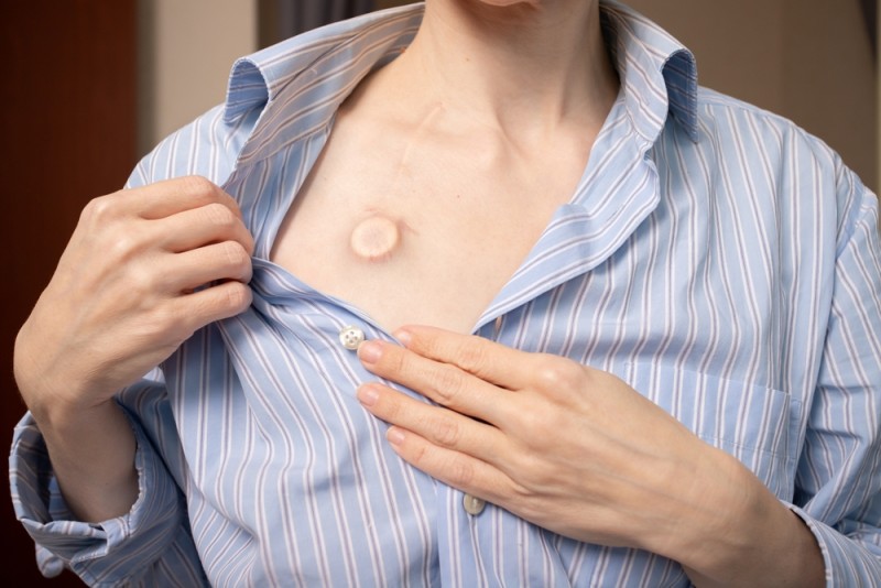 Camera implantabila chimioterapie