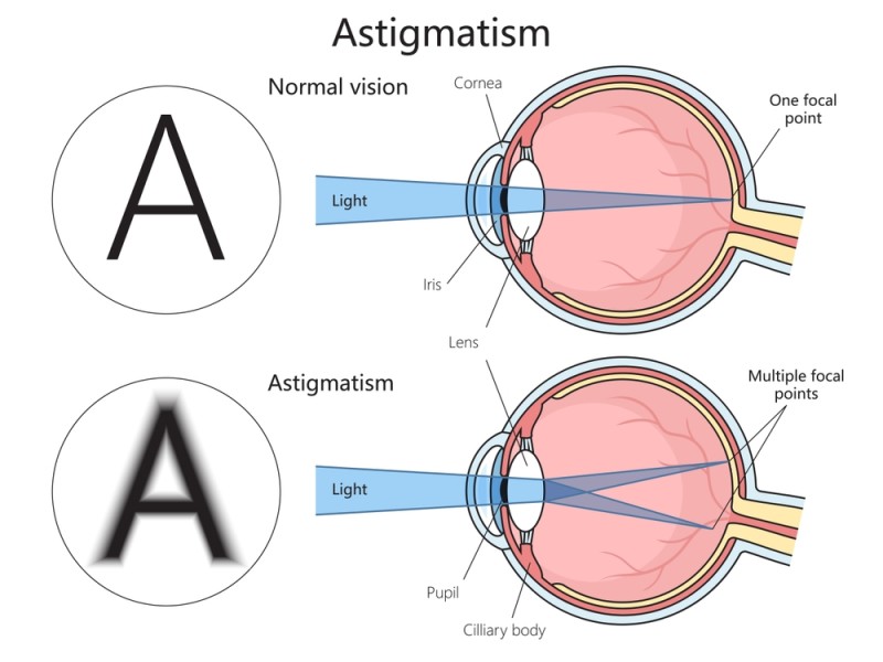 Diagrama comparativa intre vederea normala si astigmatism, ilustrand focalizarea luminii intr-un singur punct versus puncte focale multiple la nivelul retinei.