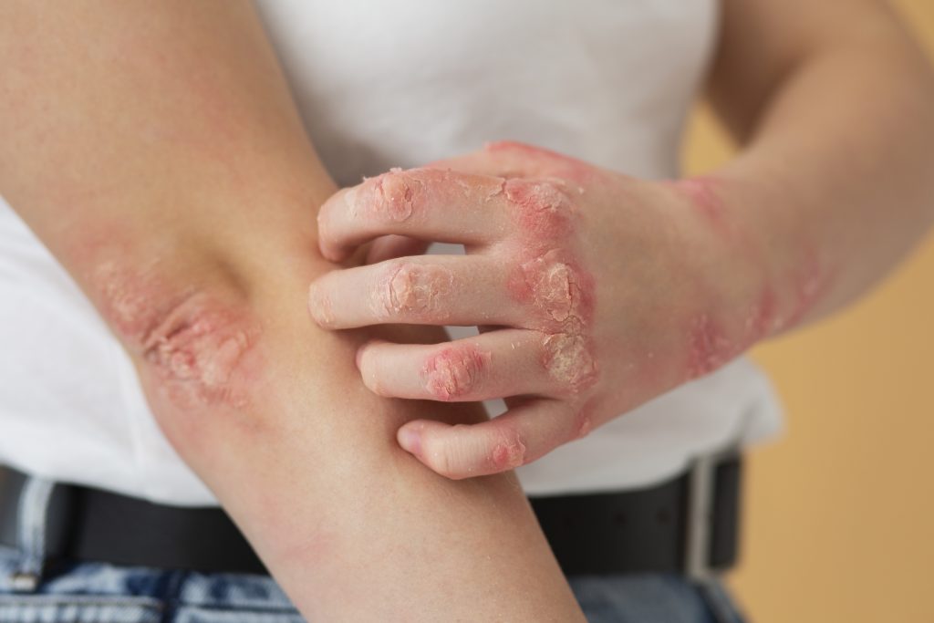  Mână care scarpină cotul afectat de dermatită atopică