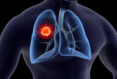 Medical,Illustration,Of,Lung,Cancer,Inside,The,Human,Lungs.