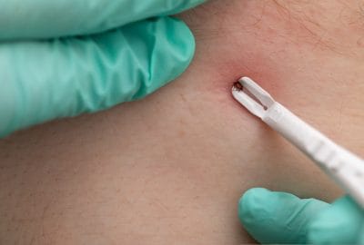 Close,Up,Picture,Human,Hand,Holding,Tweezers,,,Removing,Tick