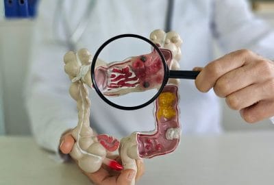 cancer colon