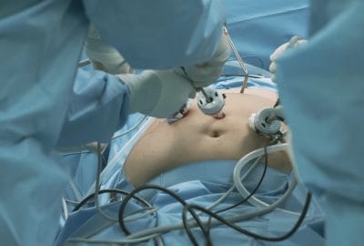 Rolul chirurgiei bariatrice în tratarea obezității morbide: mituri și realități chirurgie bariatrica