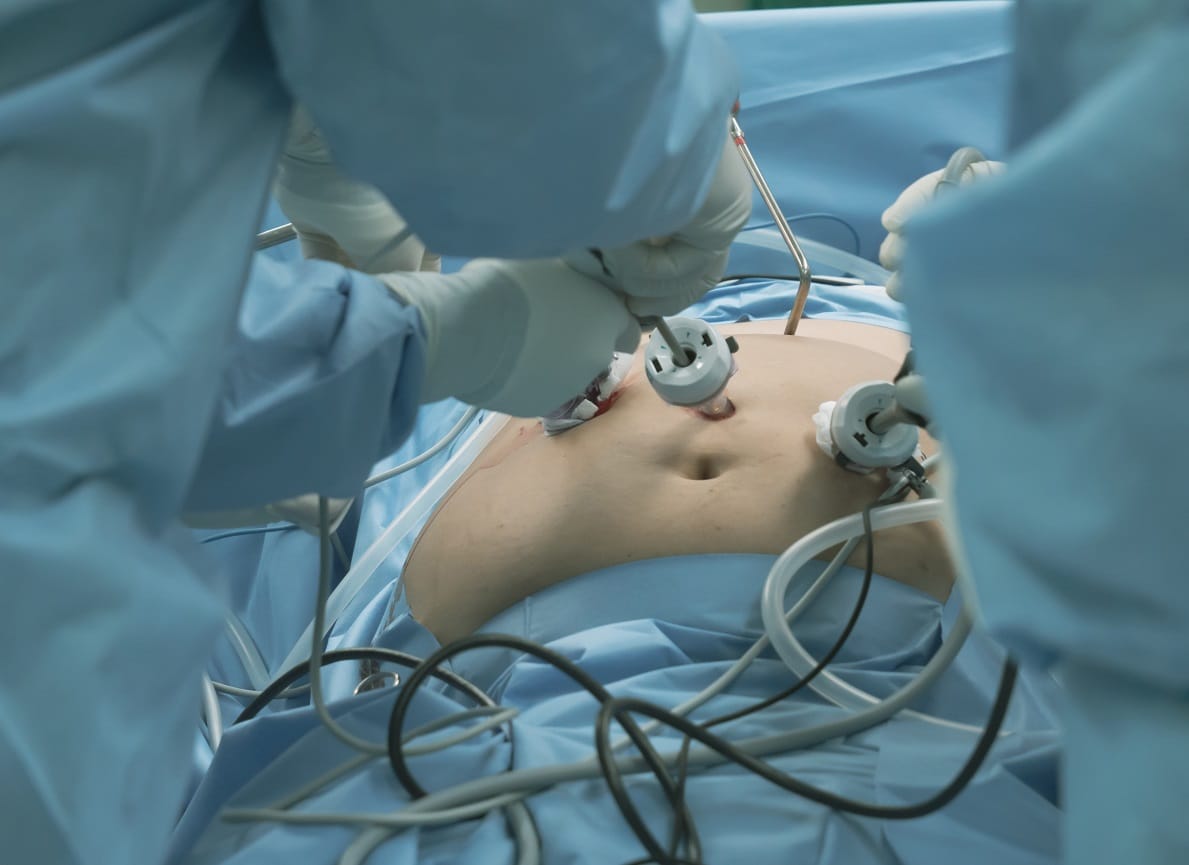 chirurgie bariatrica