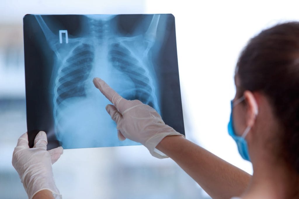 medic examineaza radiografie pulmonara