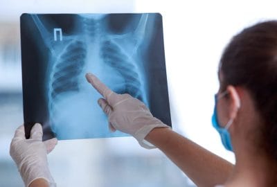 medic examineaza radiografie pulmonara 