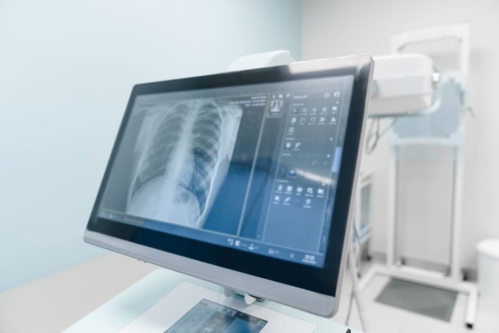 monitor afiseaza radiografie toracica 