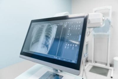 Importanța consultațiilor regulate după o operație chirurgicală cardiovasculară monitor afiseaza radiografie toracica