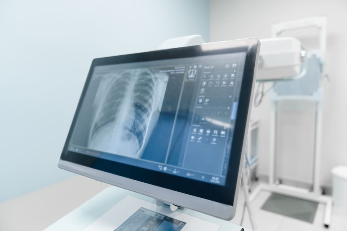 monitor afiseaza radiografie toracica