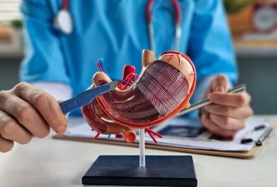 Beneficiile pe termen lung ale chirurgiei bariatrice chirurg cu bisturiu langa model anatomic stomac