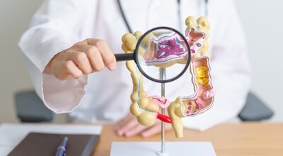 Ghidul complet privind perioada de recuperare după operația de colon Medic ține un model anatomic al colonului uman și o lupă, ilustrând afecțiuni ale intestinului gros precum cancerul colorectal, colita ulcerativă, diverticulita, sindromul de colon iritabil și bolile sistemului digestiv.