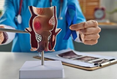 Înțelegerea simptomelor cancerului de rect: când ar trebui să consulte pacienții un specialist? Medic ține în mână o panglică albastră și un model anatomic al colonului uman, simbol al conștientizării cancerului colorectal.