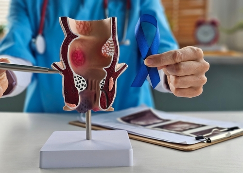 Medic ține în mână o panglică albastră și un model anatomic al colonului uman, simbol al conștientizării cancerului colorectal.