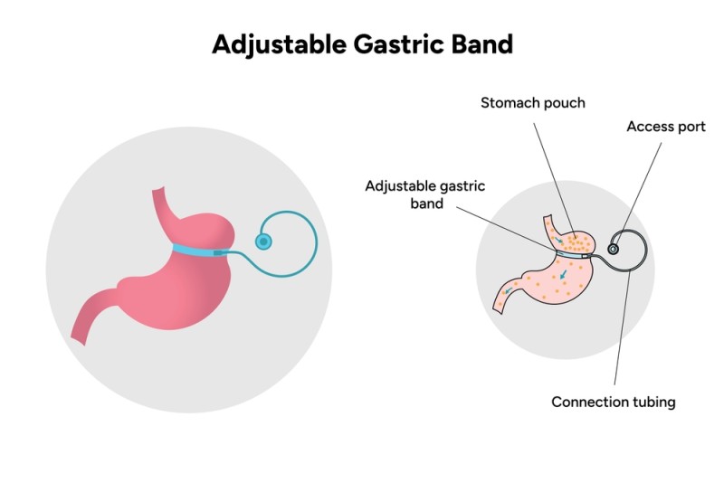 O imagine care ilustreaza procedura de montare a inelului gastric