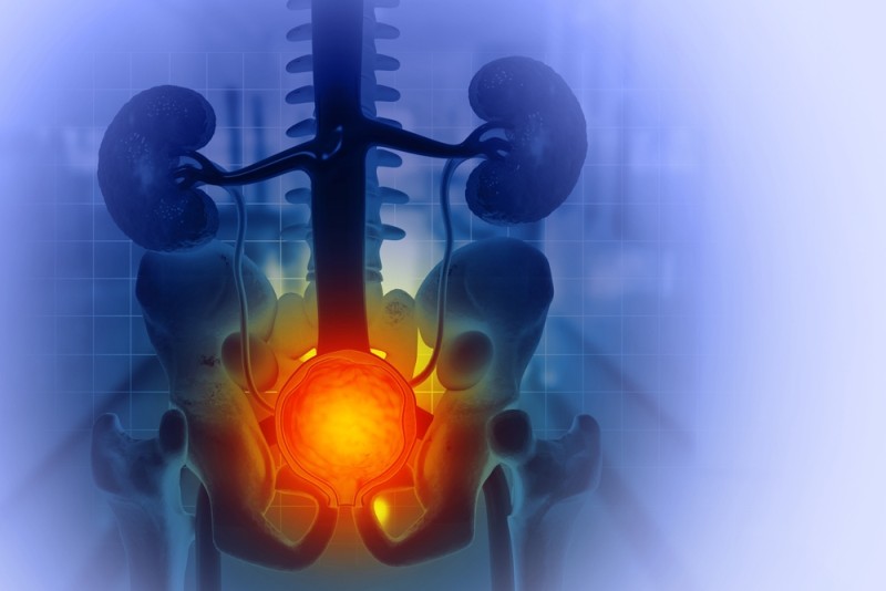 Imagine cu o procedura de embolizare a arterelor prostatice