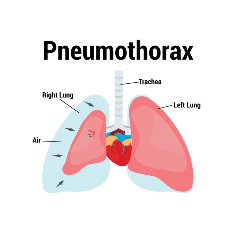 ilustratie pneumotorax