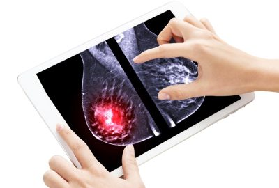 Ce este carcinomul mamar și cum apare? Cauze, simptome, evoluție și opțiuni de tratament imagine mamografie leziune mamara