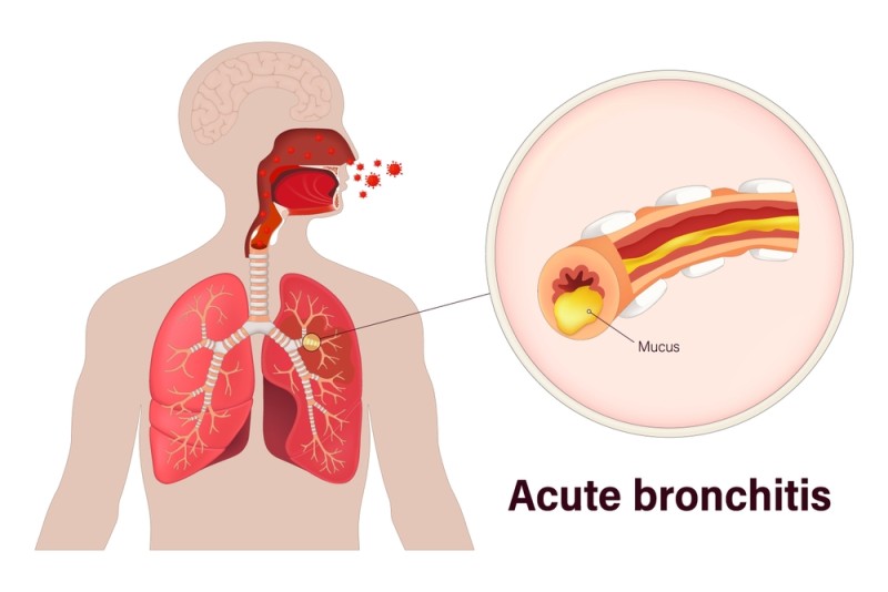 Ilustratie a cauzelor bolilor pulmonare