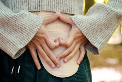 Colostomie: ce este, tipuri, indicații și procedură Imagine cu o ilustratie a procedurii colostomiei