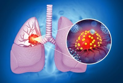 Carcinomul bronhopulmonar: forme clinice și tratament imagine reprezentand o ilustratie anatomica a plamanilor afectati de cancer