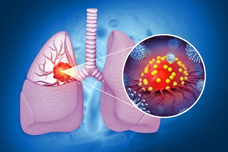 imagine reprezentand o ilustratie anatomica a plamanilor afectati de cancer
