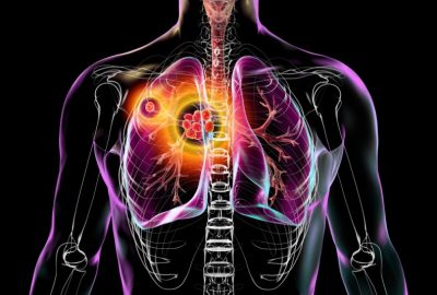 Mediastinita: ce este, cauze, simptome și tratament complet e185d232b0e4ad9d81653de5859132ff9a