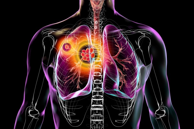 ilustratie infectie mediastin