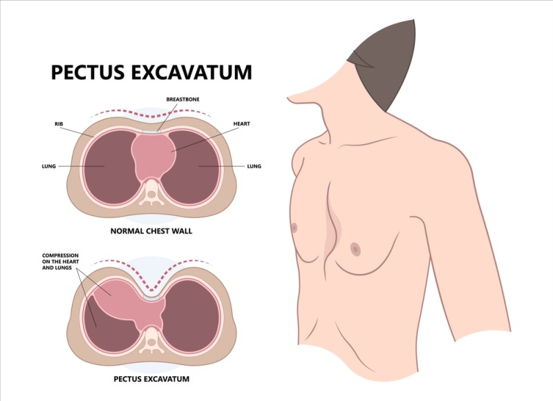 procedura Nuss, o metoda minim invaziva de corectare a pectus excavatum