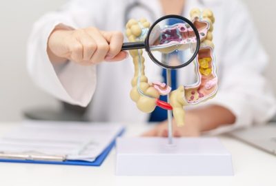 Hemicolectomie: în ce constă, când e recomandată, cum te pregătești model anatomic al colonului